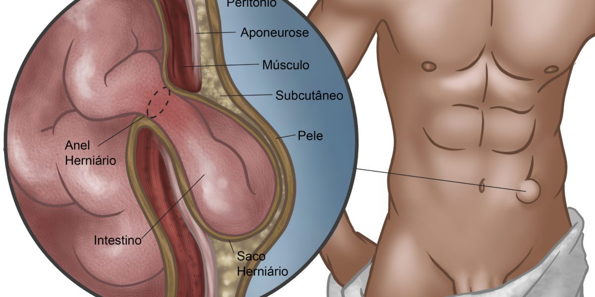 Hérnia inguinal atinge 20% dos homens em alguma fase da vida - SBH