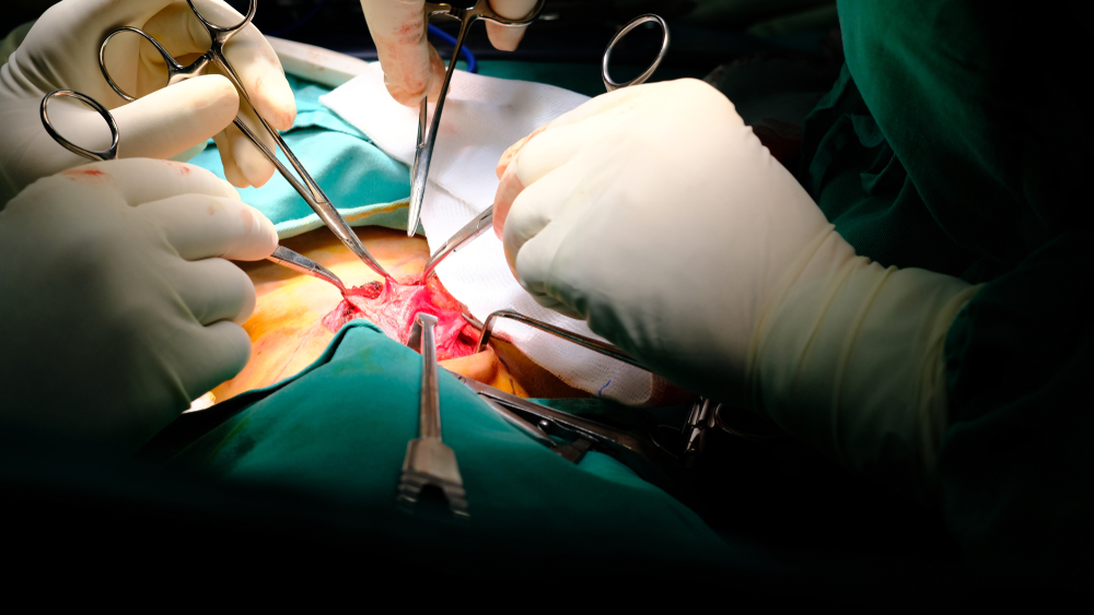 Equipe médica executa hernioplastia