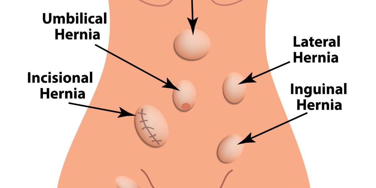 Ilustração sobre os tipos de hérnias - hérnias da parede abdominal