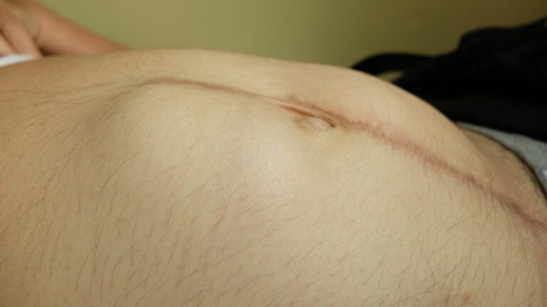 aparencia fisica de uma hernia incisional