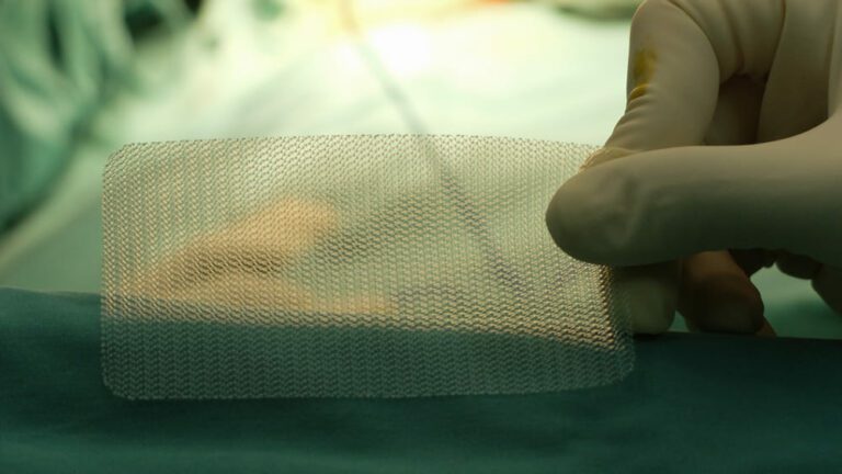 Médico segurando tela cirúrgica - cirurgia de hérnia inguinal