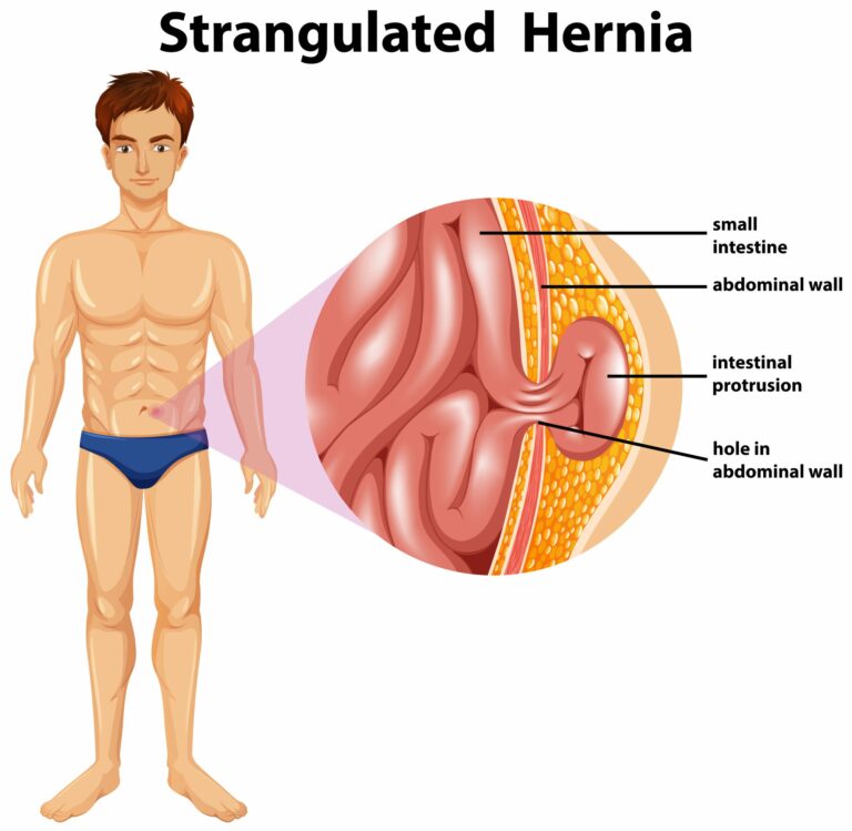 ilustração de como a hernia estrangulada é|médico ao fundo com ilustração de órgãos do aparelho digestivo