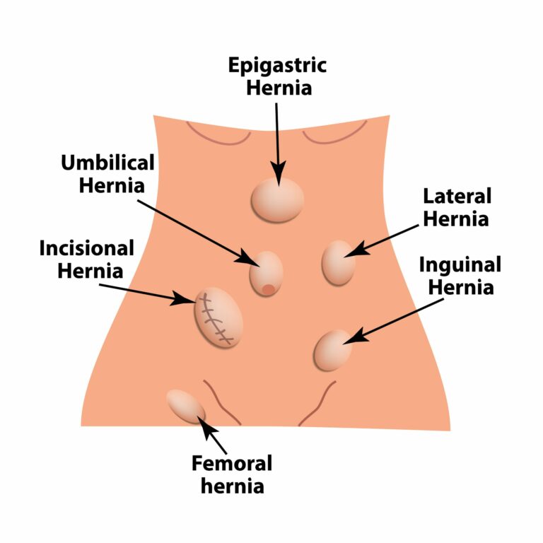 Ilustração sobre os tipos de hérnias - hérnias da parede abdominal
