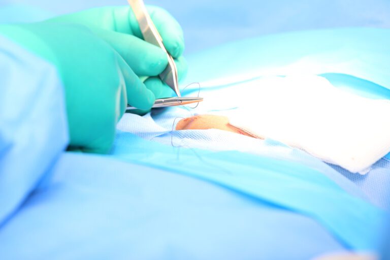 tratamento para hernia epigastrica