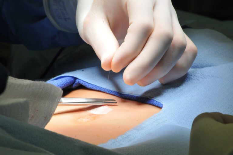 Sutura de uma cirurgia de hérnia umbilical