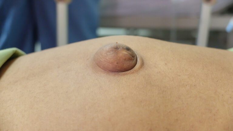 Foto de uma hérnia abdominal