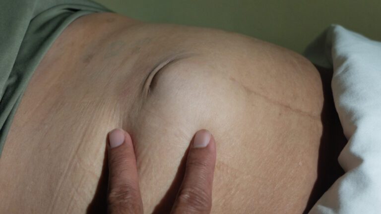 Hernia encarcerada em paciente