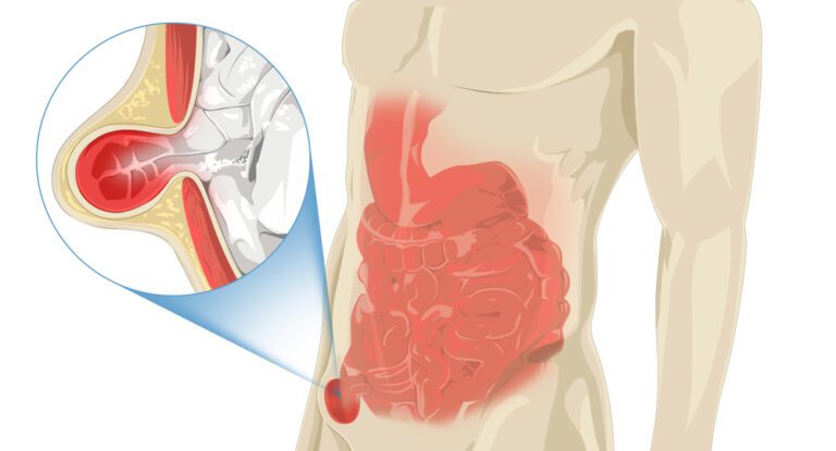 Um dos tipos de hérnia ventral