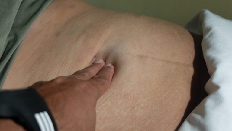 Mão apertando hérnia em barriga de paciente.