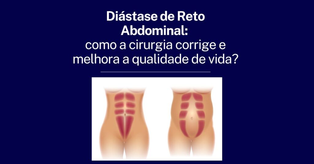 Comparação entre músculos abdominais normais (à esquerda) e músculos com diástase (à direita), mostrando o afastamento dos músculos na condição de diástase abdominal.