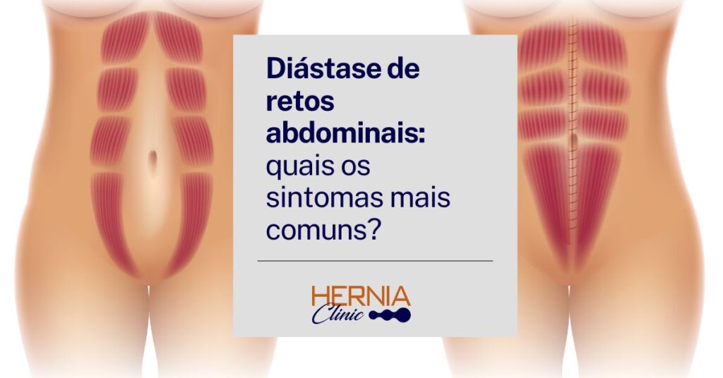 Ilustração comparativa do abdômen mostrando a diástase dos músculos retos abdominais à esquerda e a correção muscular à direita.