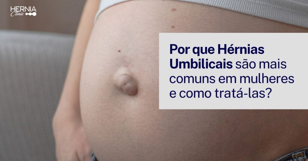 Barriga de uma pessoa com hérnia umbilical evidente, destacando a protuberância na região do umbigo, ilustrando a condição médica.