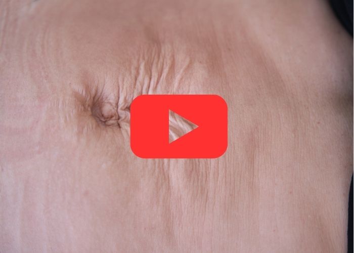 Close-up de uma cicatriz ou deformidade na região abdominal de uma pessoa, sugerindo sinais visíveis de hérnia na pele.