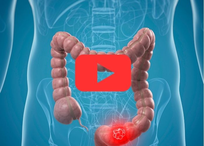 O ChatGPT disse: Ilustração do intestino grosso com destaque em vermelho para possível tumor colorretal na porção final do cólon.