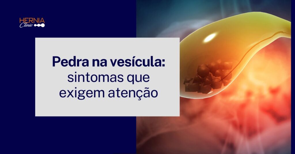 Imagem ilustrando a formação de pedras na vesícula, destacando o acúmulo de cálculos na bile.