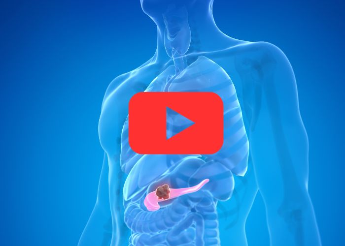 Ilustração médica do corpo humano transparente com destaque para o pâncreas em rosa e presença de tumor marrom.