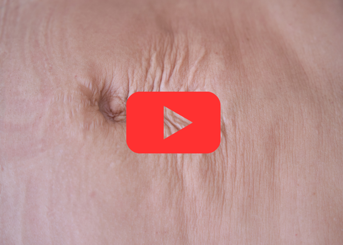 Pessoa com diástase abdominal masculina visível, mostrando afastamento dos músculos retos do abdômen e pele enrugada na região central.