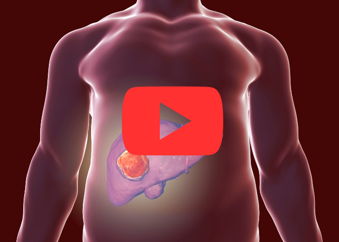 Ilustração de um tronco humano mostrando o fígado com uma lesão em destaque, representando possível tumor hepático.