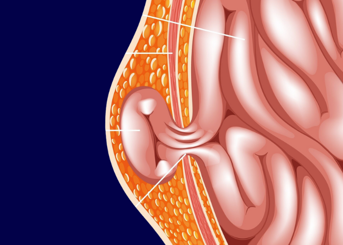 Ilustração médica mostrando uma hérnia inguinal, com parte do intestino protrudindo através da parede abdominal e destacada por camadas anatômicas.
