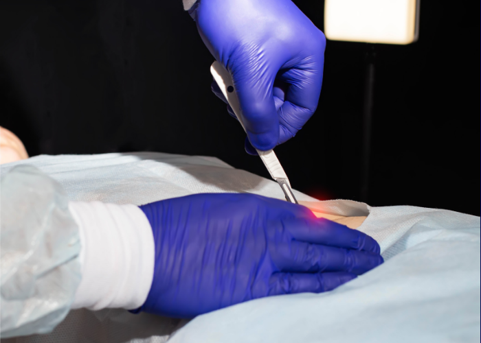 Mãos com luvas cirúrgicas manipulam instrumento sobre pele incisa, em ambiente médico iluminado e estéril.