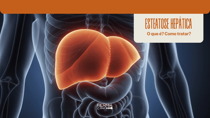 Ilustração médica do fígado em destaque no abdômen humano, com órgãos internos visíveis, representando saúde e doenças hepáticas.
