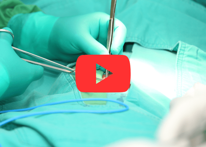 Procedimento cirúrgico abdominal com instrumentos médicos atuando na região umbilical, em ambiente hospitalar estéril.