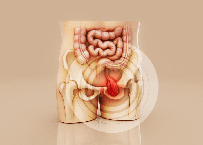 Ilustração do sistema digestivo e região pélvica com destaque para área anal, representando desconforto ou condição intestinal.