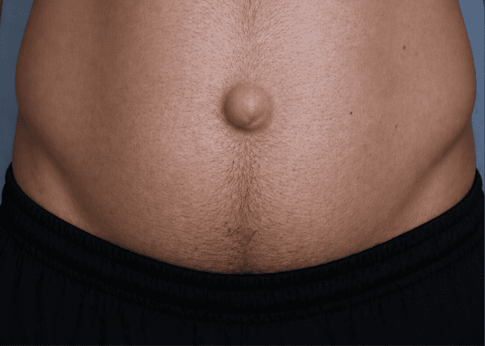 Abdômen masculino com saliência na região do umbigo, sugerindo possível hérnia ou abaulamento abdominal.