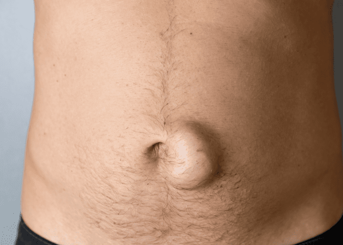 Pessoa toca a região abdominal com expressão de desconforto, sugerindo dor ou possível recorrência de problema na área.