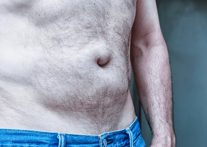 Abdômen masculino com saliência na região do umbigo, indicando possível hérnia umbilical.