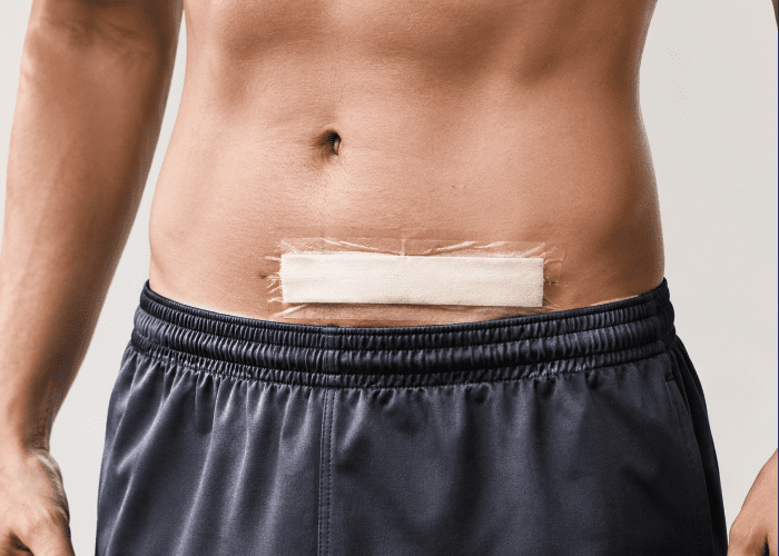 Homem no pós-operatório de hérnia abdominal, com curativo sobre a incisão na região inferior do abdômen.