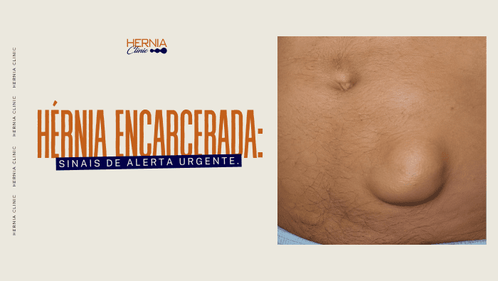 Abdômen masculino com grande saliência abdominal localizada, sugerindo possível hérnia encarcerada.