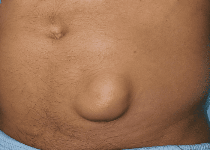 Abdômen masculino com grande saliência abdominal localizada, sugerindo possível hérnia encarcerada.