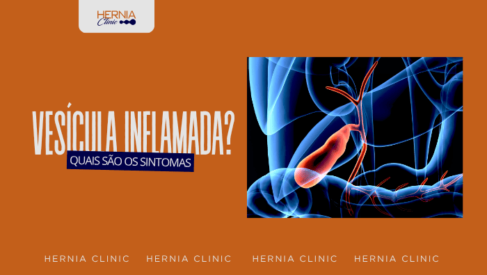 Ilustração anatômica da vesícula biliar em destaque, representando inflamação da vesícula e alterações nas vias biliares.