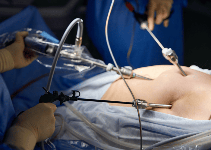 Equipe médica realizando cirurgia laparoscópica com instrumentos minimamente invasivos, representando colecistectomia e tratamento da vesícula biliar.