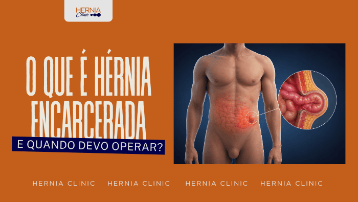 O que é hérnia encarcerada e quando devo operar? 1 Ilustração anatômica de hérnia encarcerada na região abdominal, mostrando alça intestinal presa na parede abdominal.