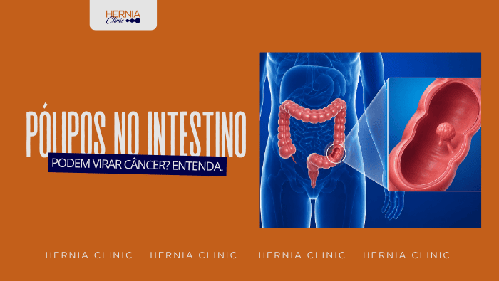 Ilustração anatômica do intestino grosso com destaque para um pólipo no cólon, acompanhada de ampliação mostrando o interior do intestino com a lesão.