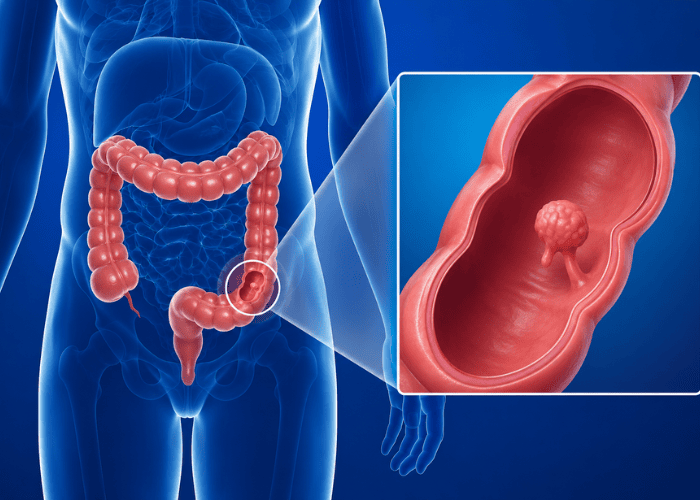 Ilustração anatômica do intestino grosso com destaque para um pólipo no cólon, acompanhada de ampliação mostrando o interior do intestino com a lesão.