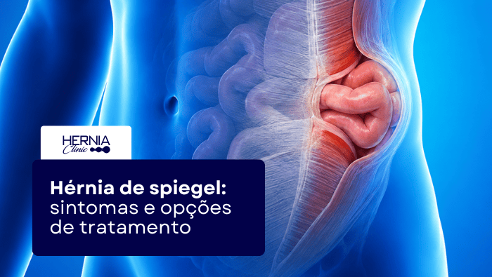 Hérnia de Spiegel: sintomas e opções de tratamento 1 Arte sobre hérnia de Spiegel com ilustração da parede abdominal