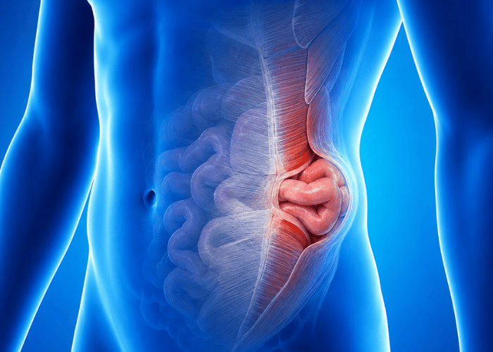 Ilustração anatômica mostrando hérnia na parede abdominal