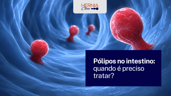 Arte sobre pólipos no intestino e necessidade de tratamento