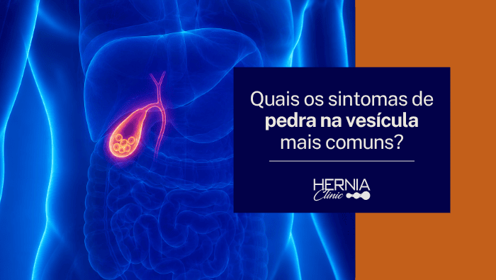 Quais os sintomas de pedra na vesícula mais comuns? 1 Ilustração anatômica do abdômen em transparência, com fígado, intestinos e vesícula biliar em destaque, mostrando cálculos no interior da vesícula.