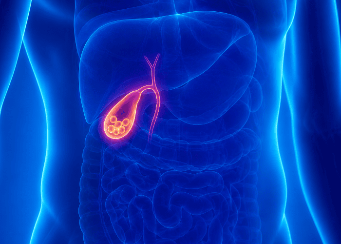 Ilustração anatômica do abdômen em transparência, com fígado, intestinos e vesícula biliar em destaque, mostrando cálculos no interior da vesícula.