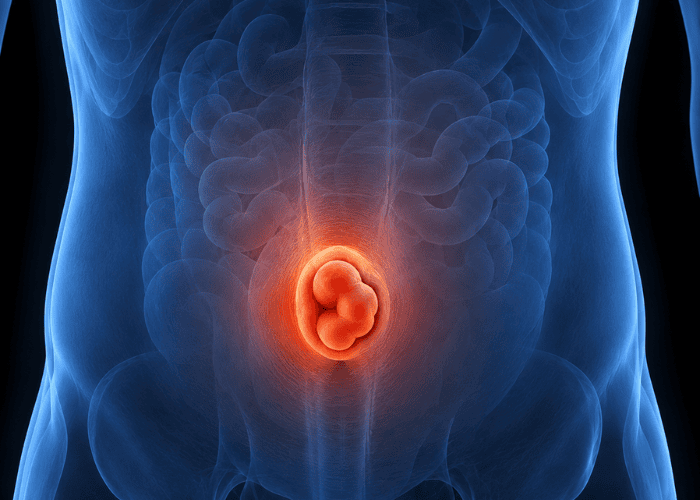 Ilustração médica de hérnia umbilical no abdômen