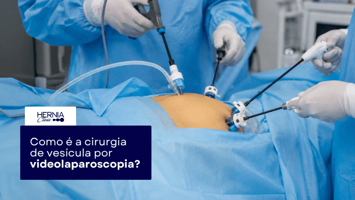 Arte sobre cirurgia de vesícula por videolaparoscopia