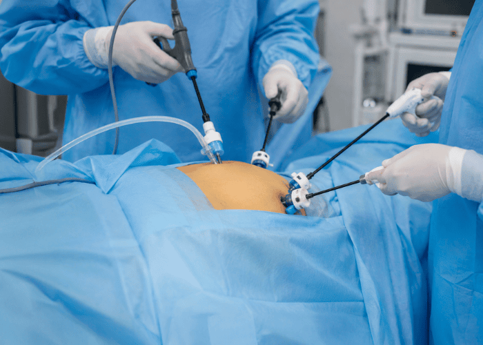 Cirurgia por videolaparoscopia sendo realizada no abdômen