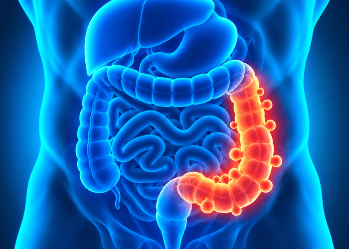 Ilustração médica do intestino grosso com doença diverticular