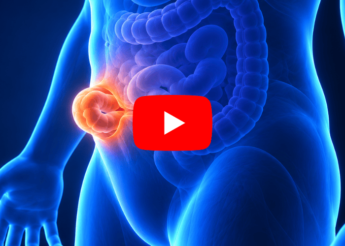Ilustração médica de hérnia abdominal após cirurgia